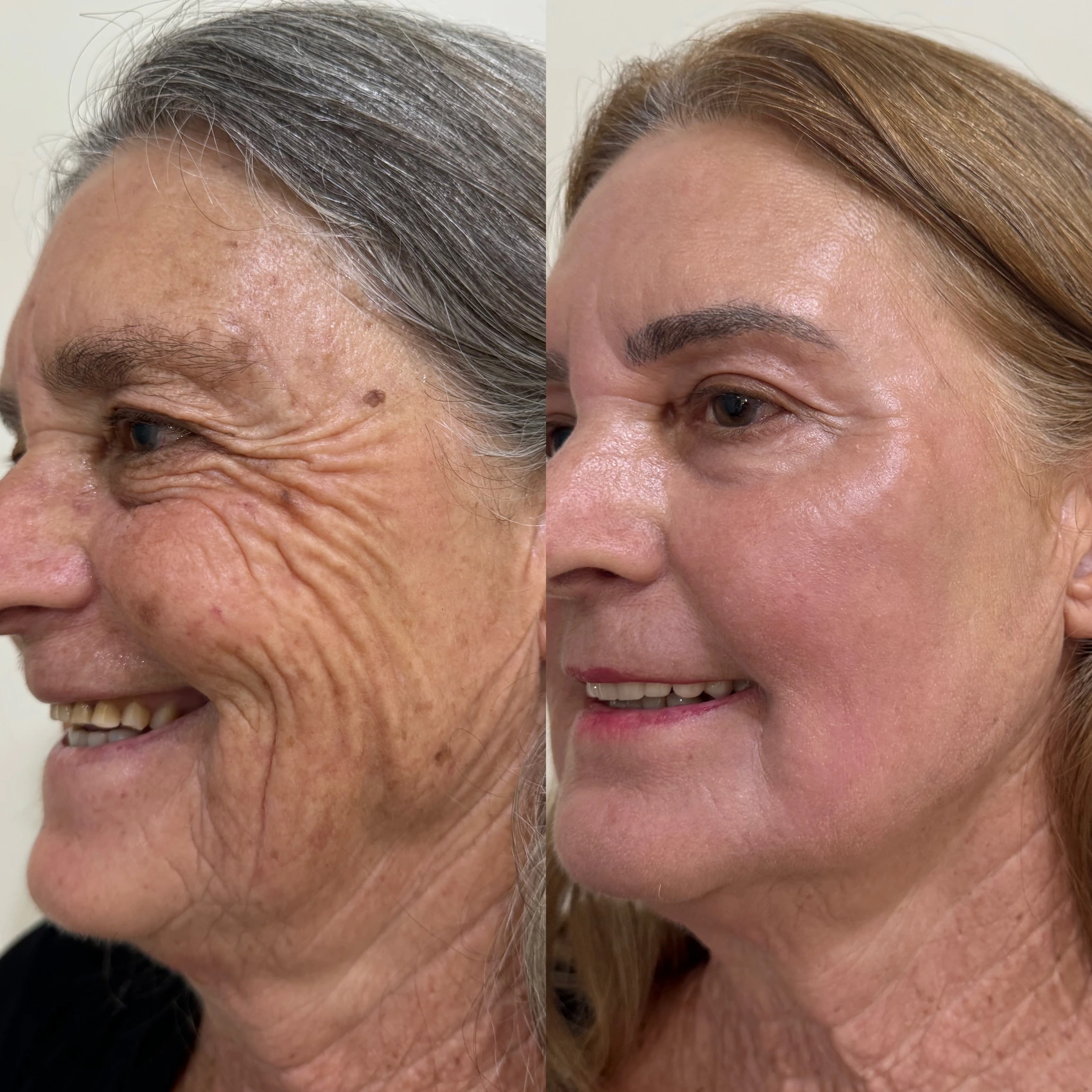 Antes e depois de paciente tratada pela Dra. Vanessa Goes - resultado 1