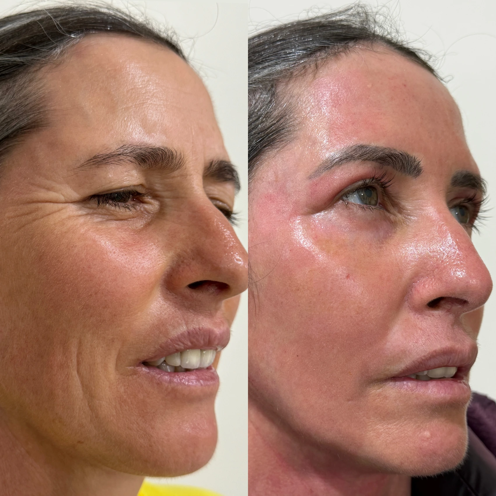 Antes e depois de paciente tratada pela Dra. Vanessa Goes - resultado 2