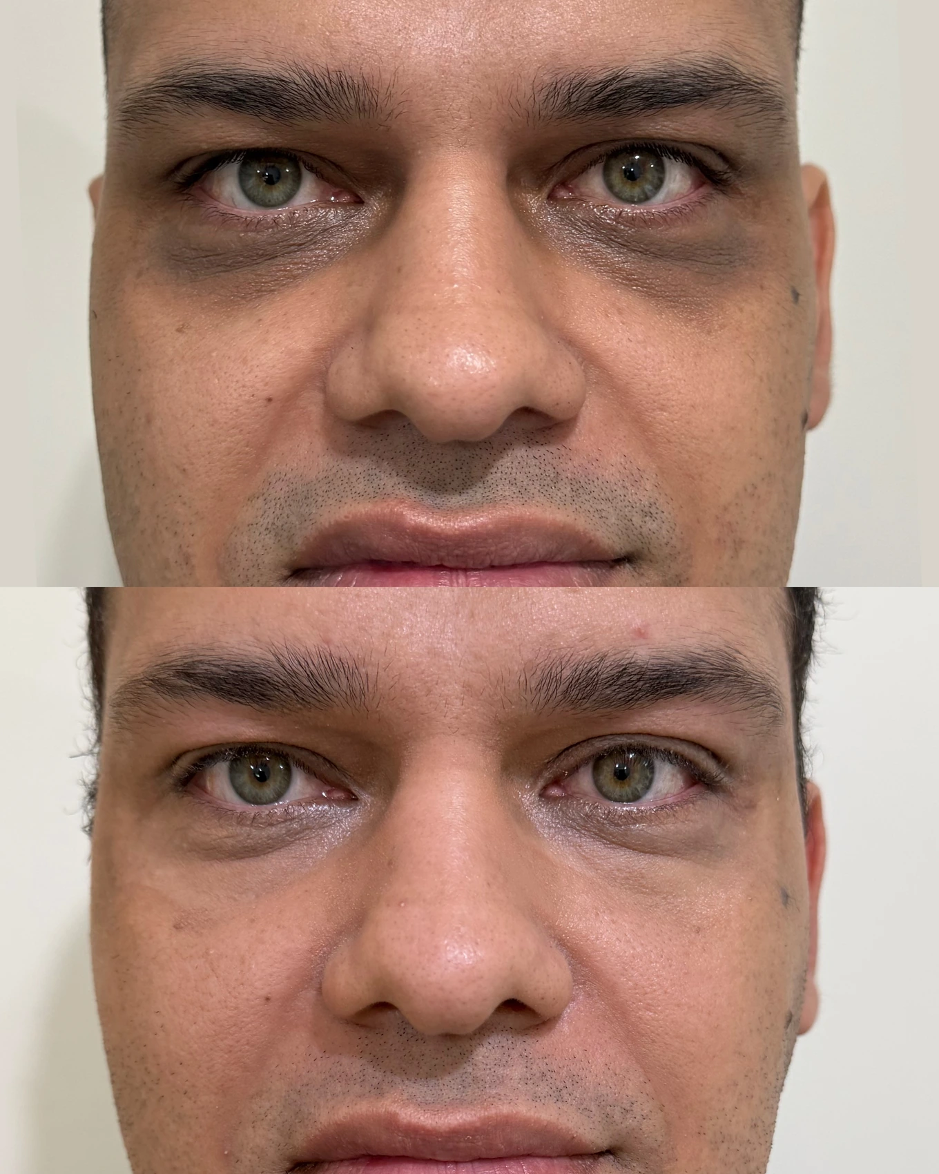 Antes e depois de paciente tratada pela Dra. Vanessa Goes - resultado 3