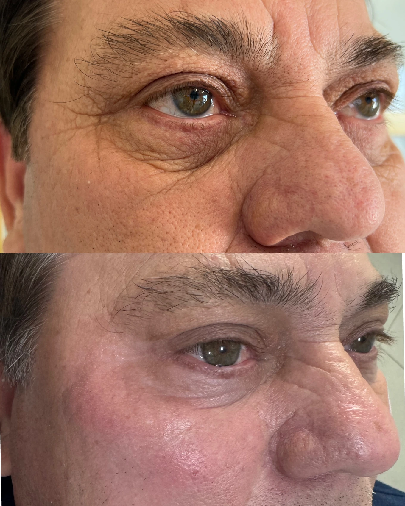 Antes e depois de paciente tratada pela Dra. Vanessa Goes - resultado 4