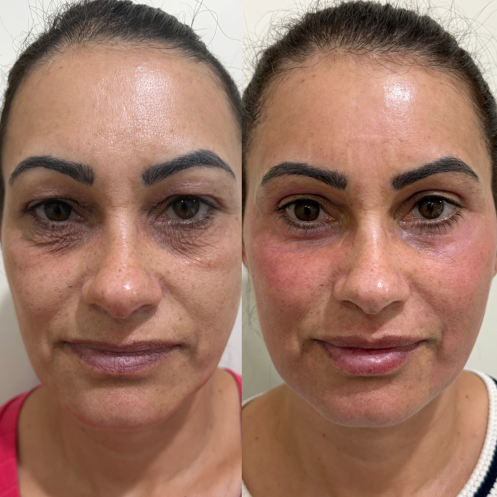 Antes e depois de paciente tratada pela Dra. Vanessa Goes - resultado 5