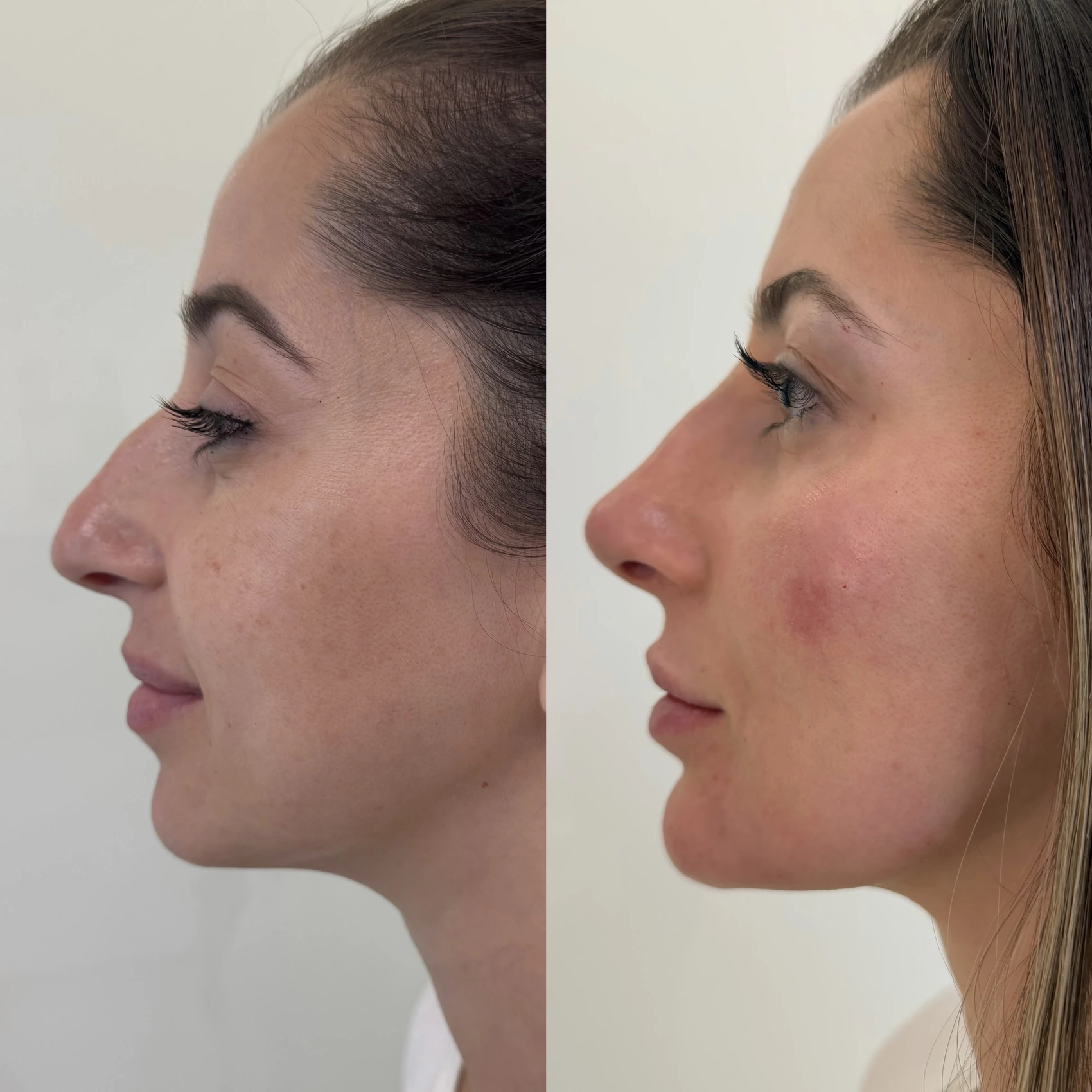 Antes e depois de paciente tratada pela Dra. Vanessa Goes - resultado 6