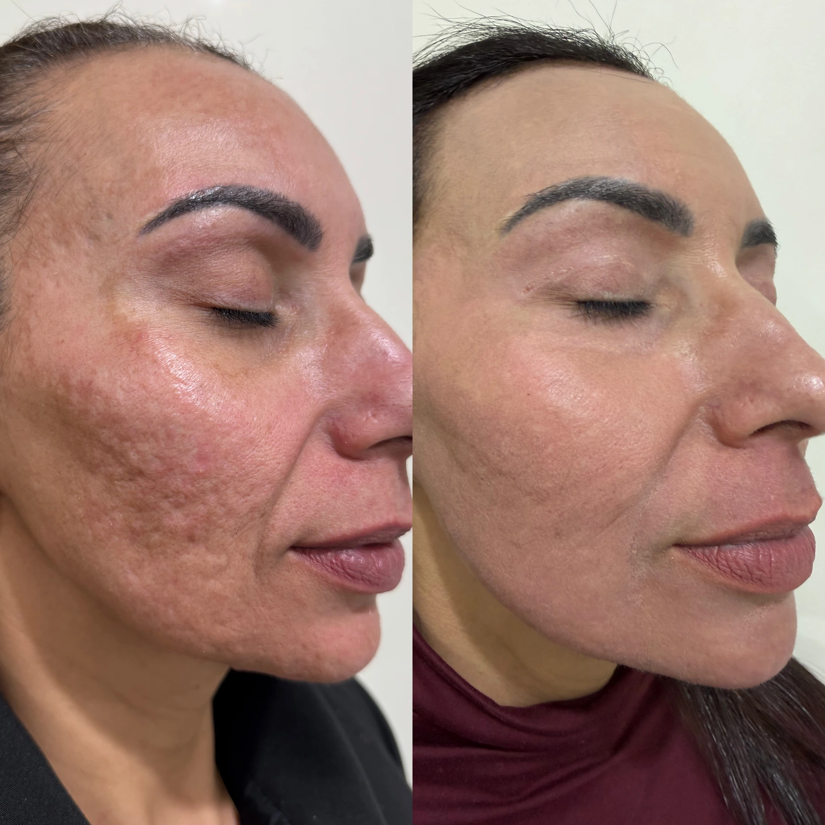 Antes e depois de paciente tratada pela Dra. Vanessa Goes - resultado 7