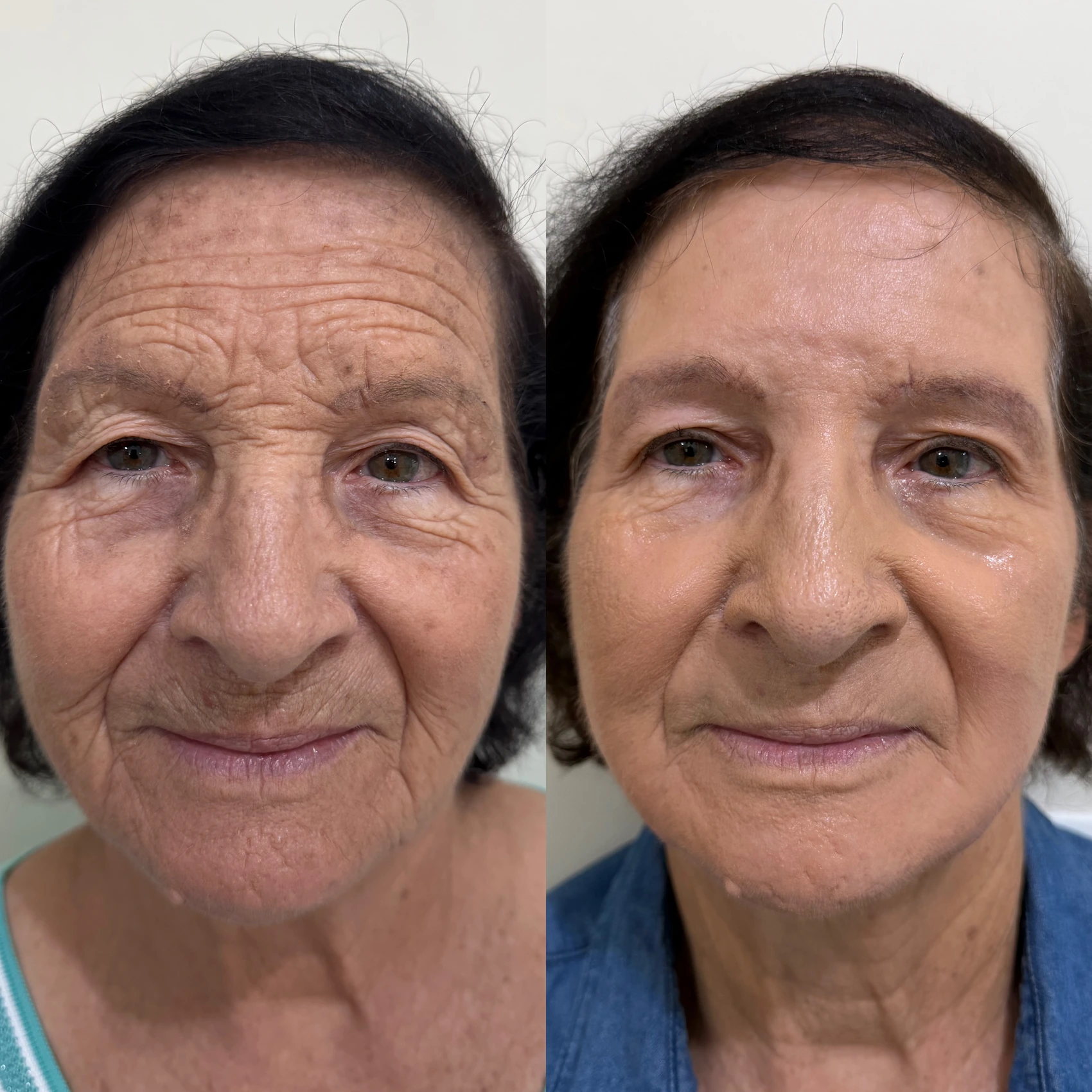 Antes e depois de paciente tratada pela Dra. Vanessa Goes - resultado 8