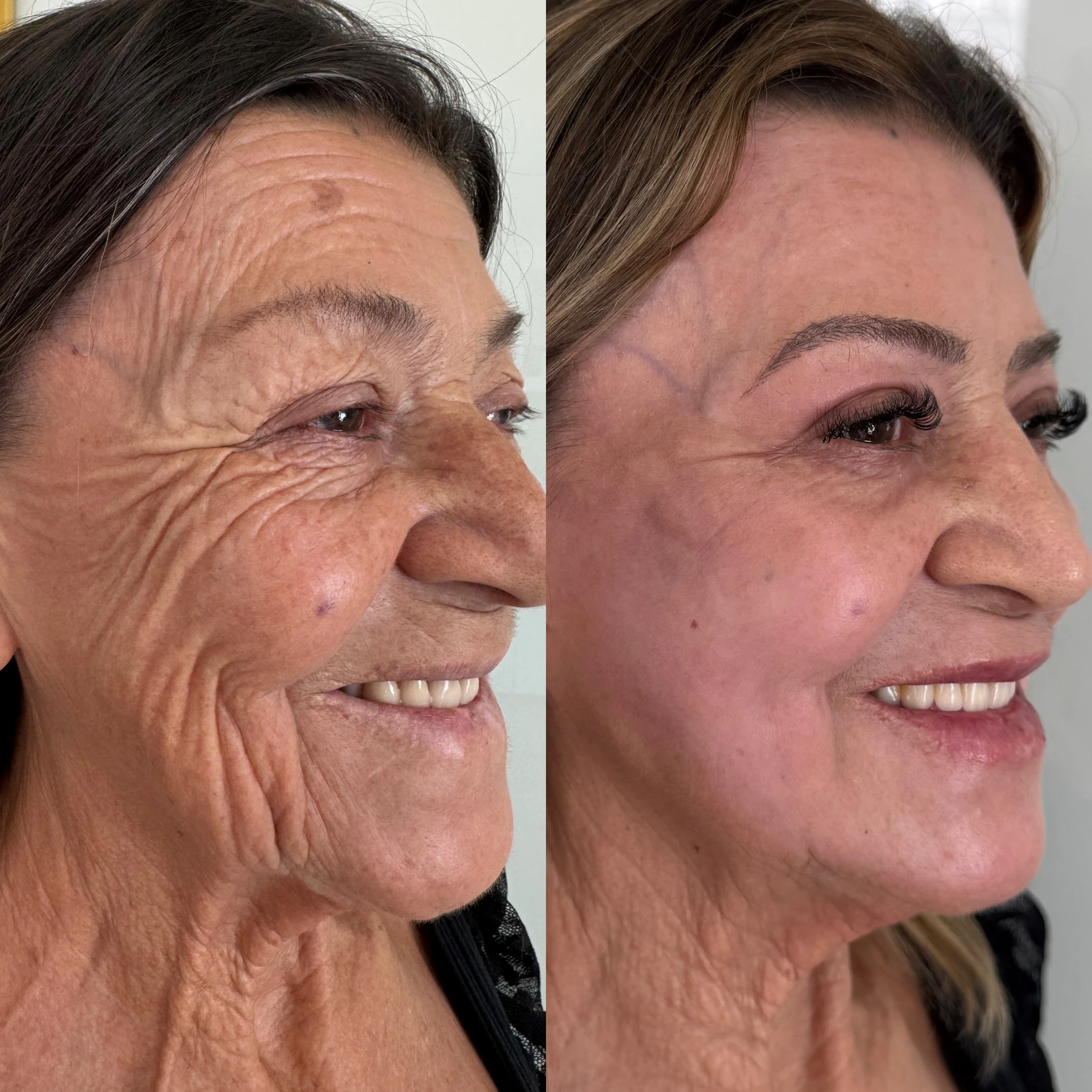 Antes e depois de paciente tratada pela Dra. Vanessa Goes - resultado 9