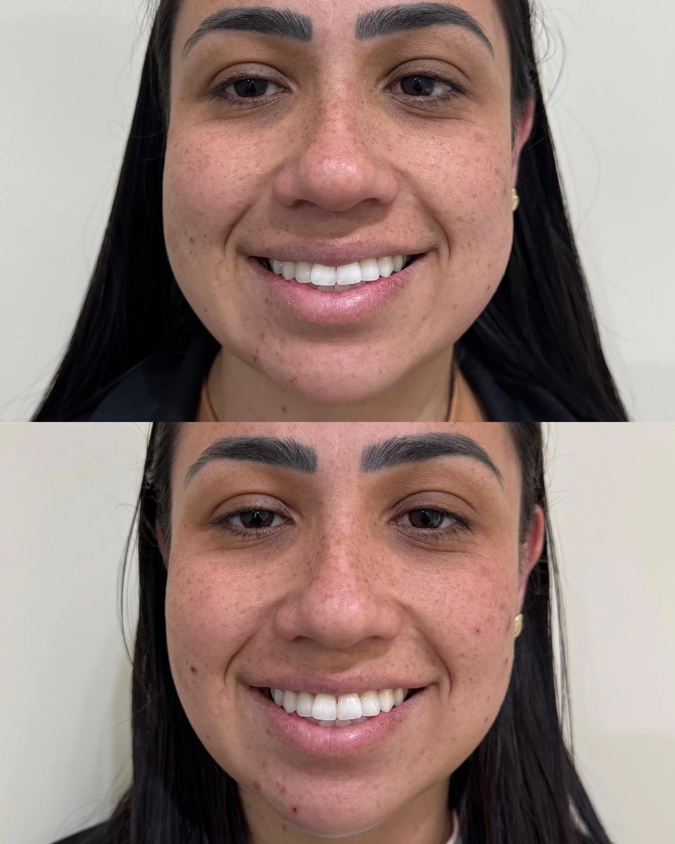 Antes e depois de paciente tratada pela Dra. Vanessa Goes - resultado 10