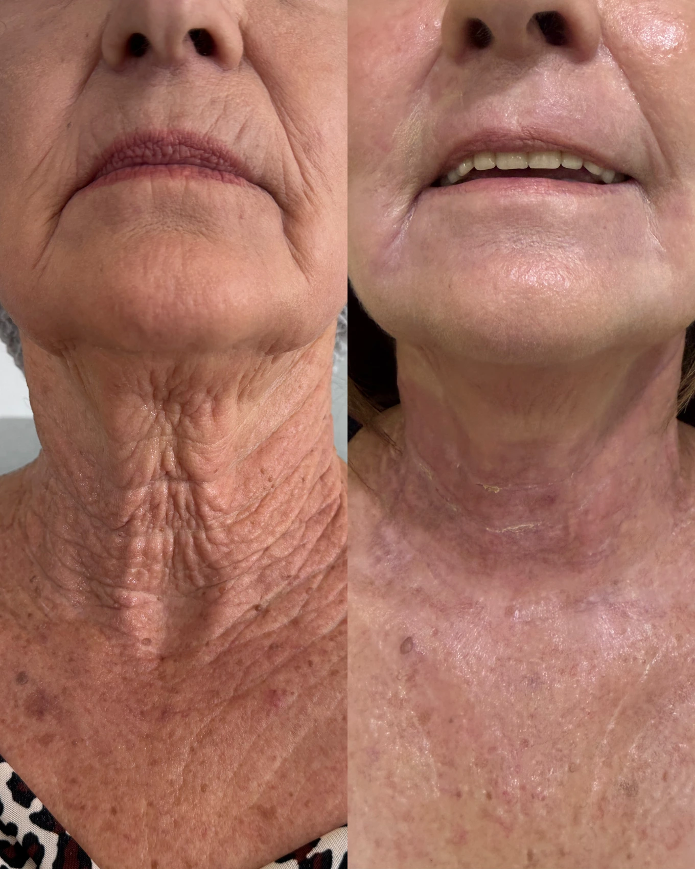 Antes e depois de paciente tratada pela Dra. Vanessa Goes - resultado 11