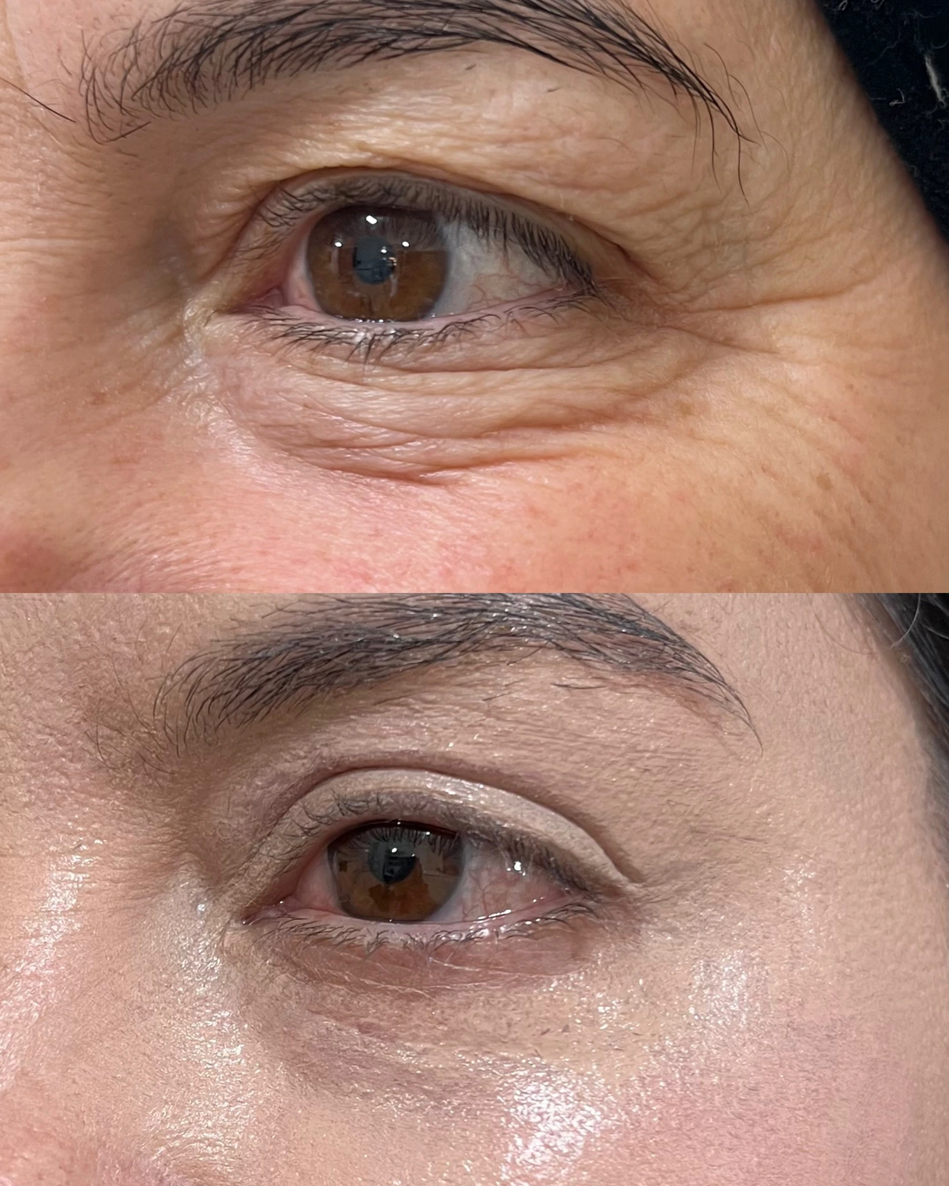 Antes e depois de paciente tratada pela Dra. Vanessa Goes - resultado 12