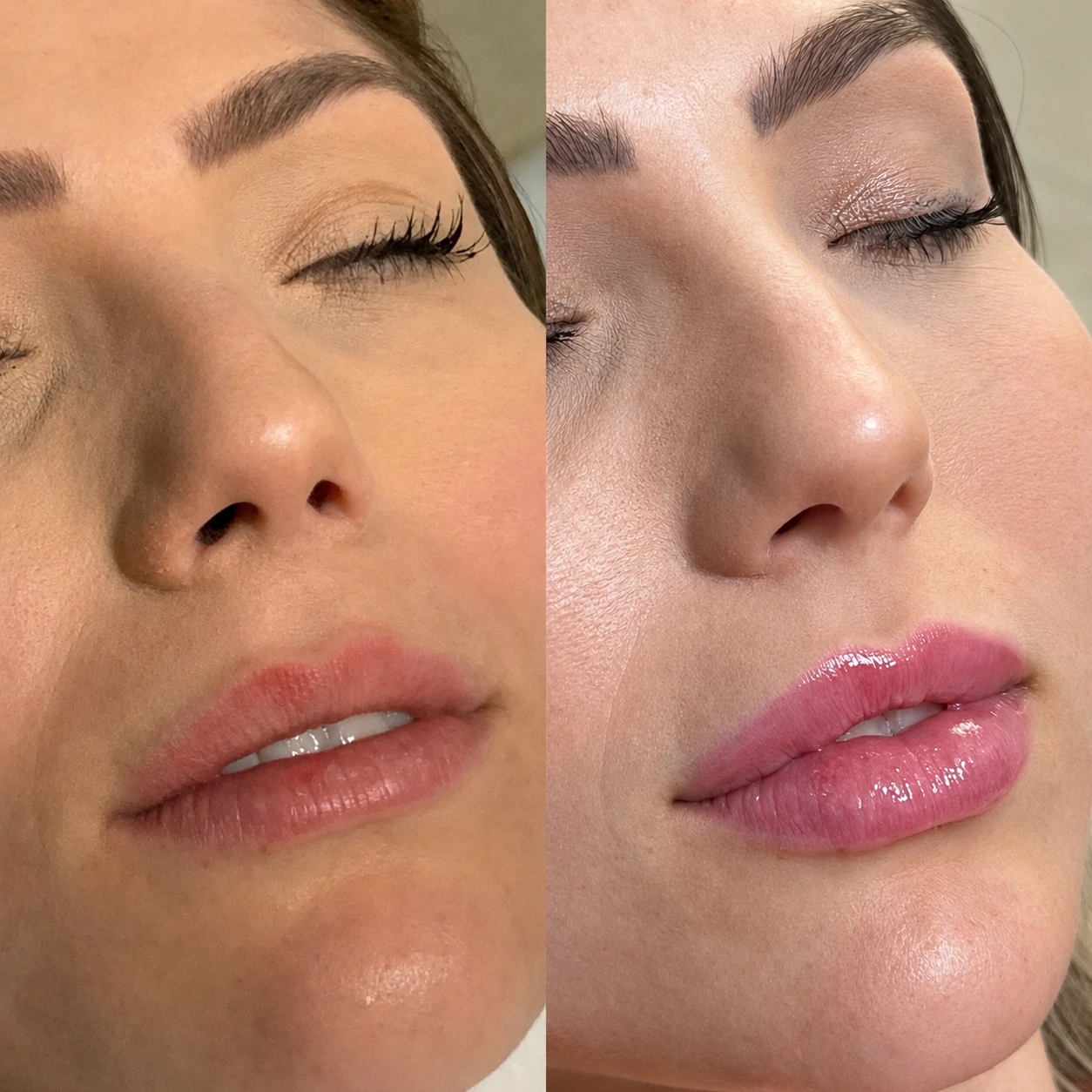 Antes e depois de paciente tratada pela Dra. Vanessa Goes - resultado 13