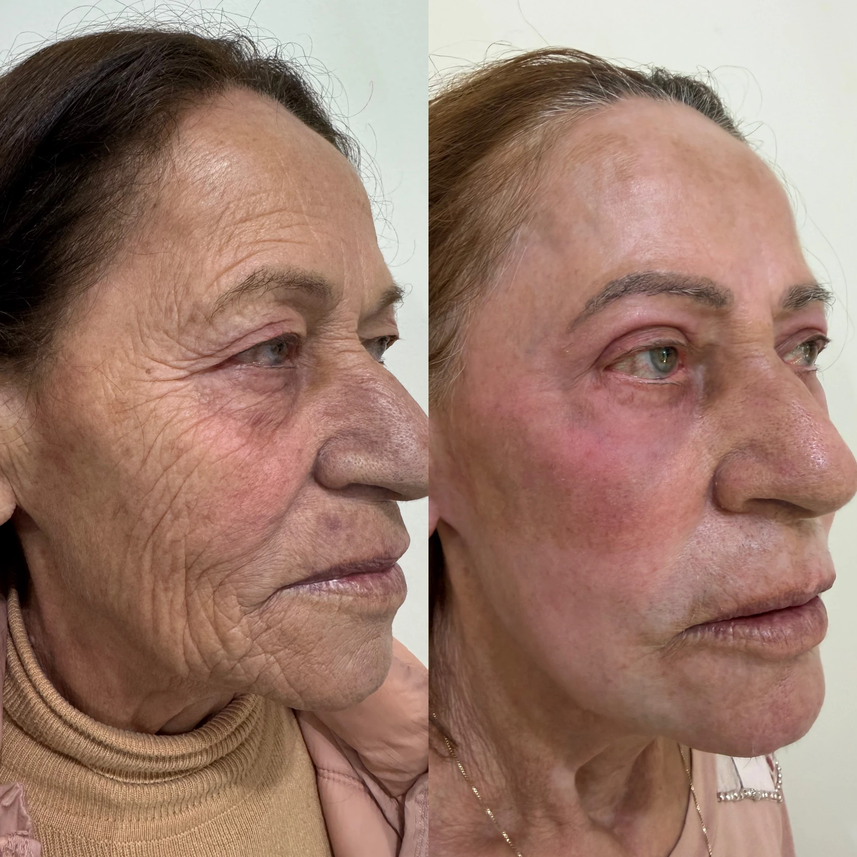 Antes e depois de paciente tratada pela Dra. Vanessa Goes - resultado 14