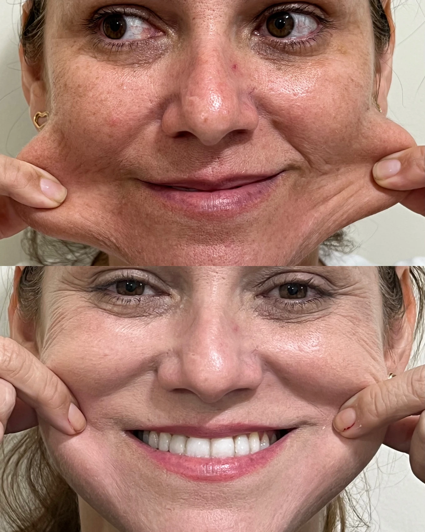 Antes e depois de paciente tratada pela Dra. Vanessa Goes - resultado 15