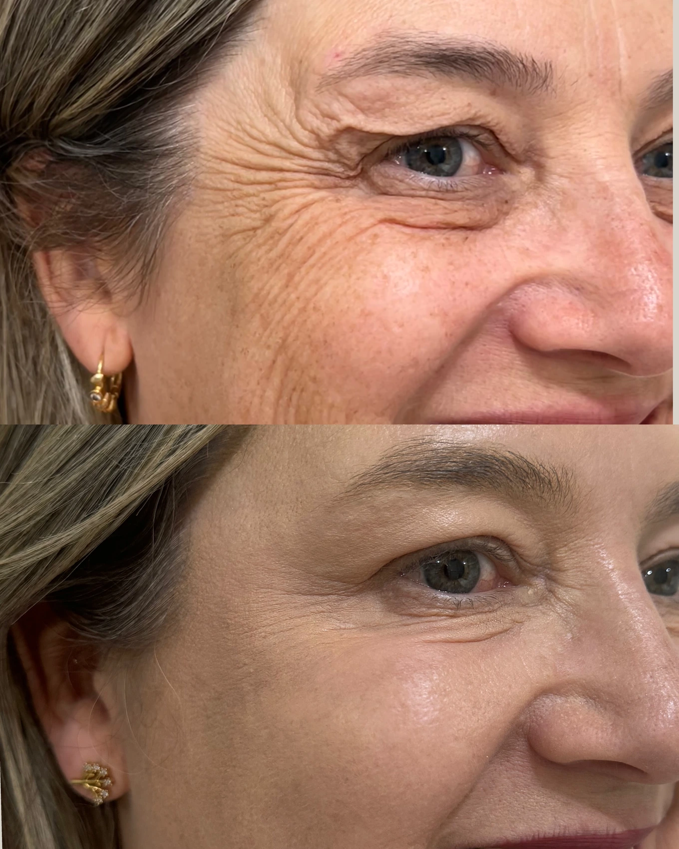 Antes e depois de paciente tratada pela Dra. Vanessa Goes - resultado 16