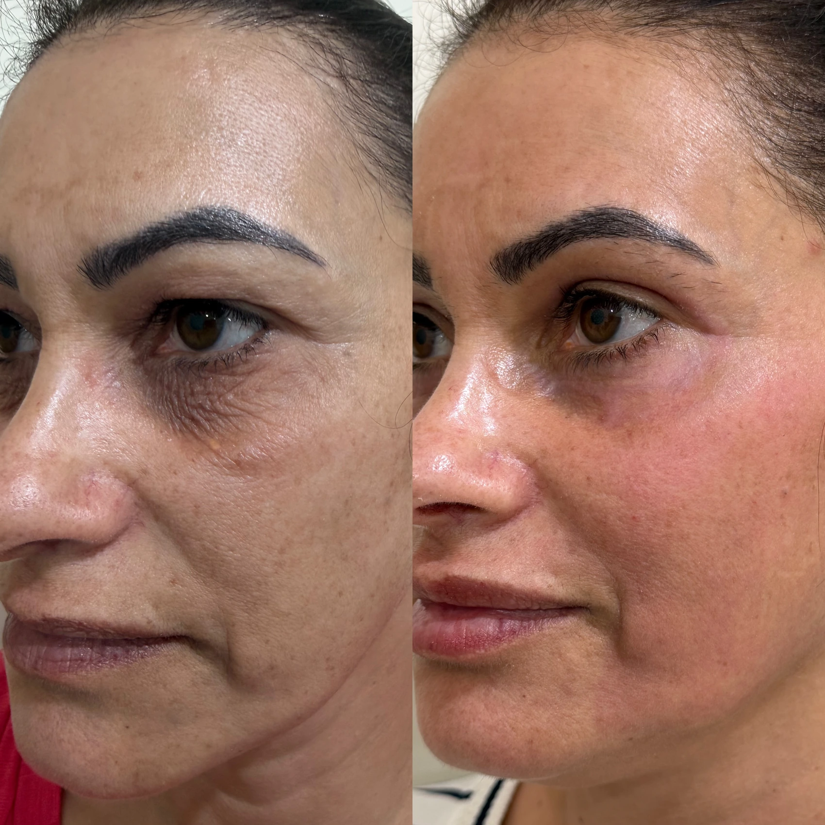 Antes e depois de paciente tratada pela Dra. Vanessa Goes - resultado 17