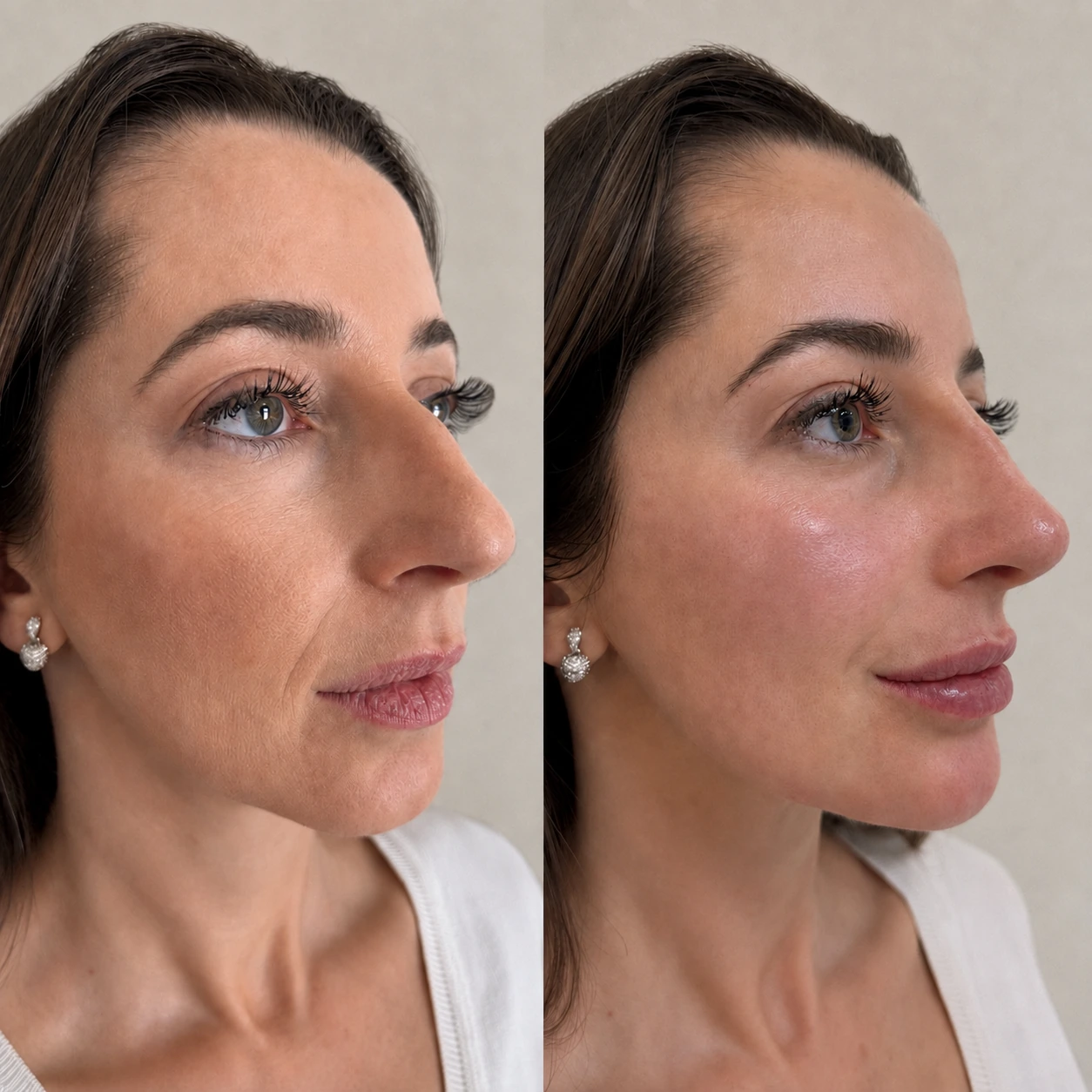 Antes e depois de paciente tratada pela Dra. Vanessa Goes - resultado 18