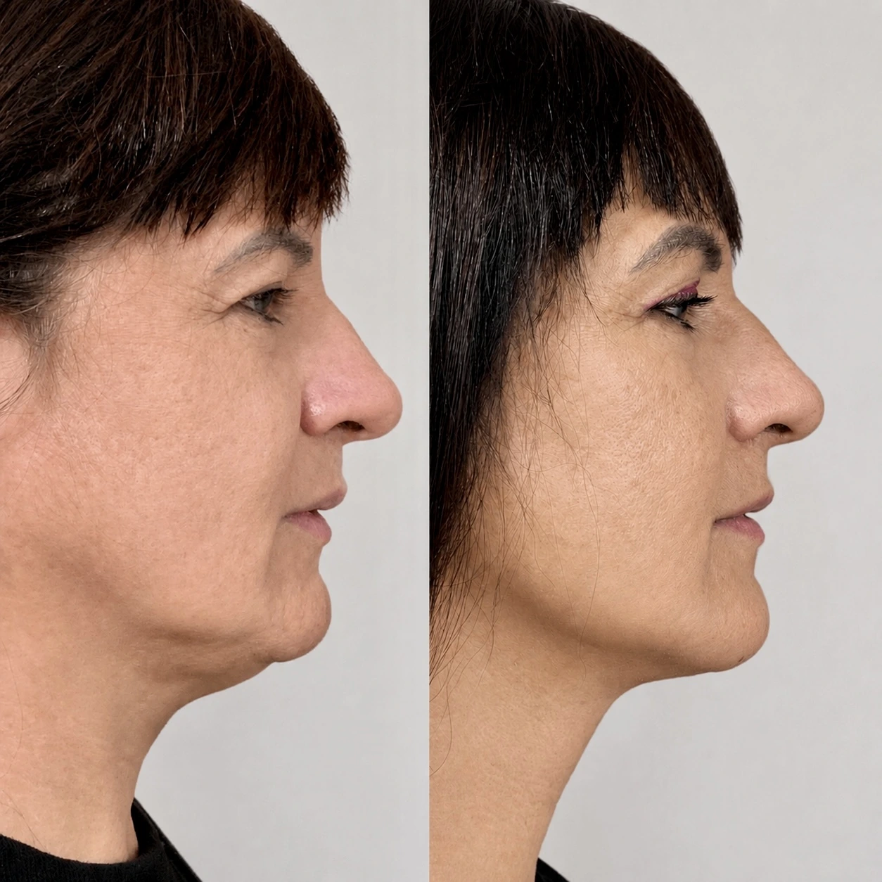 Antes e depois de paciente tratada pela Dra. Vanessa Goes - resultado 19