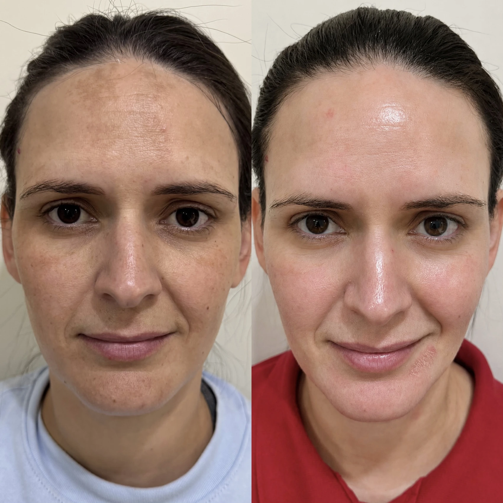 Antes e depois de paciente tratada pela Dra. Vanessa Goes - resultado 20