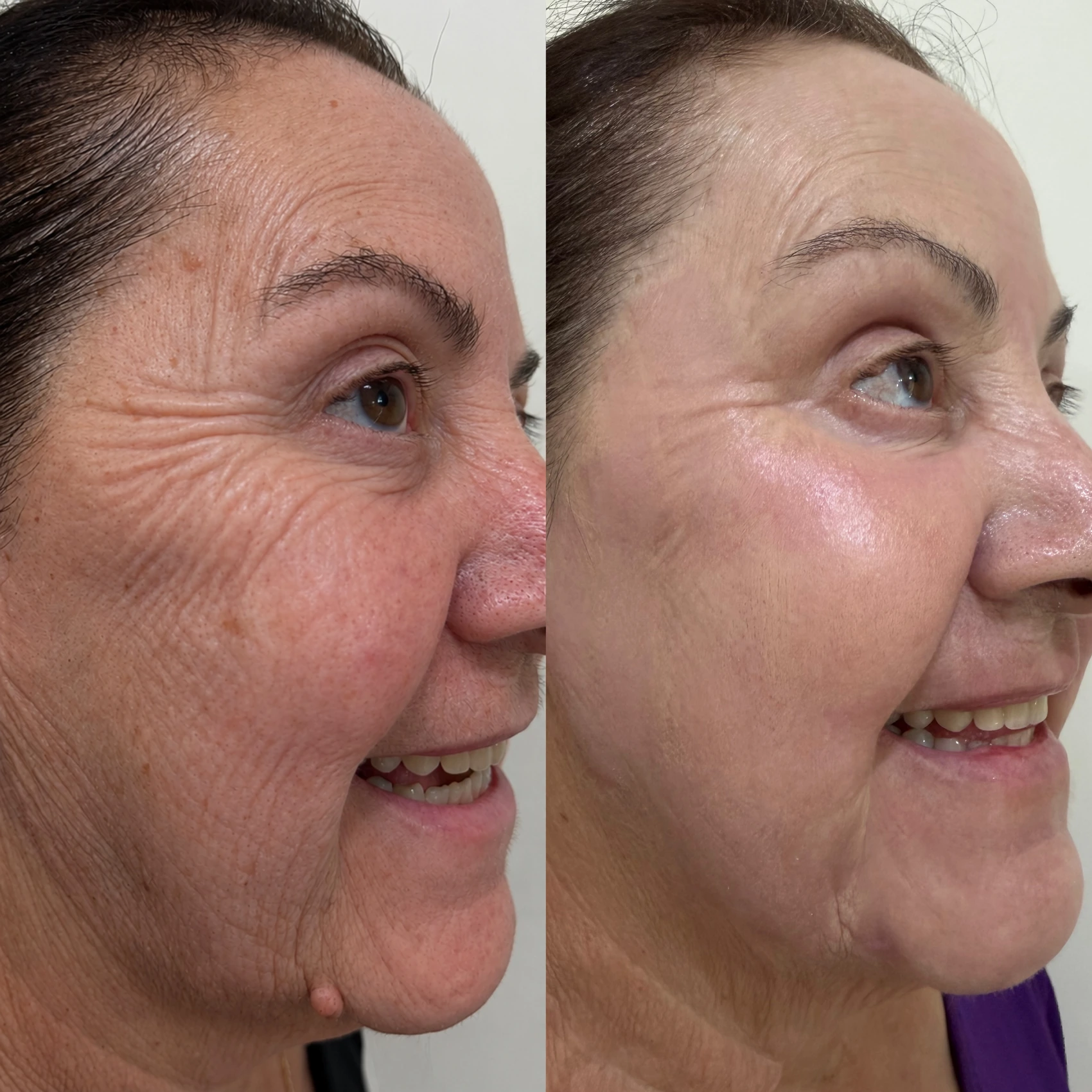 Antes e depois de paciente tratada pela Dra. Vanessa Goes - resultado 21