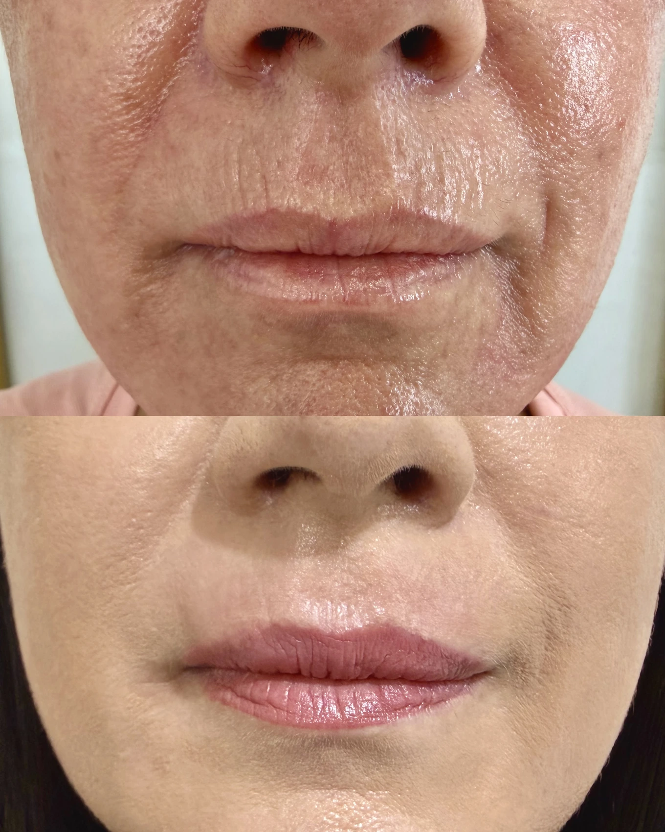 Antes e depois de paciente tratada pela Dra. Vanessa Goes - resultado 22