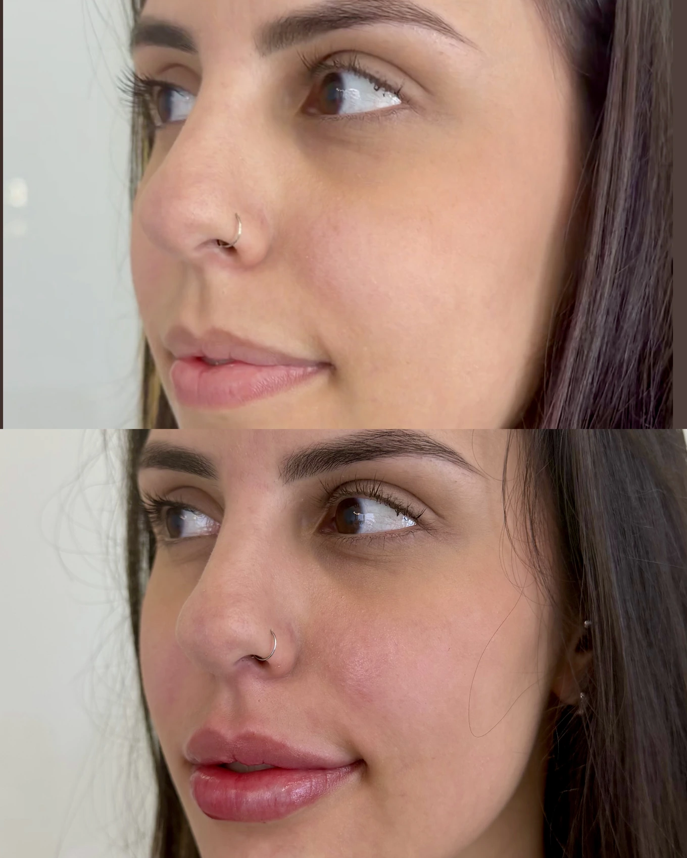 Antes e depois de paciente tratada pela Dra. Vanessa Goes - resultado 23