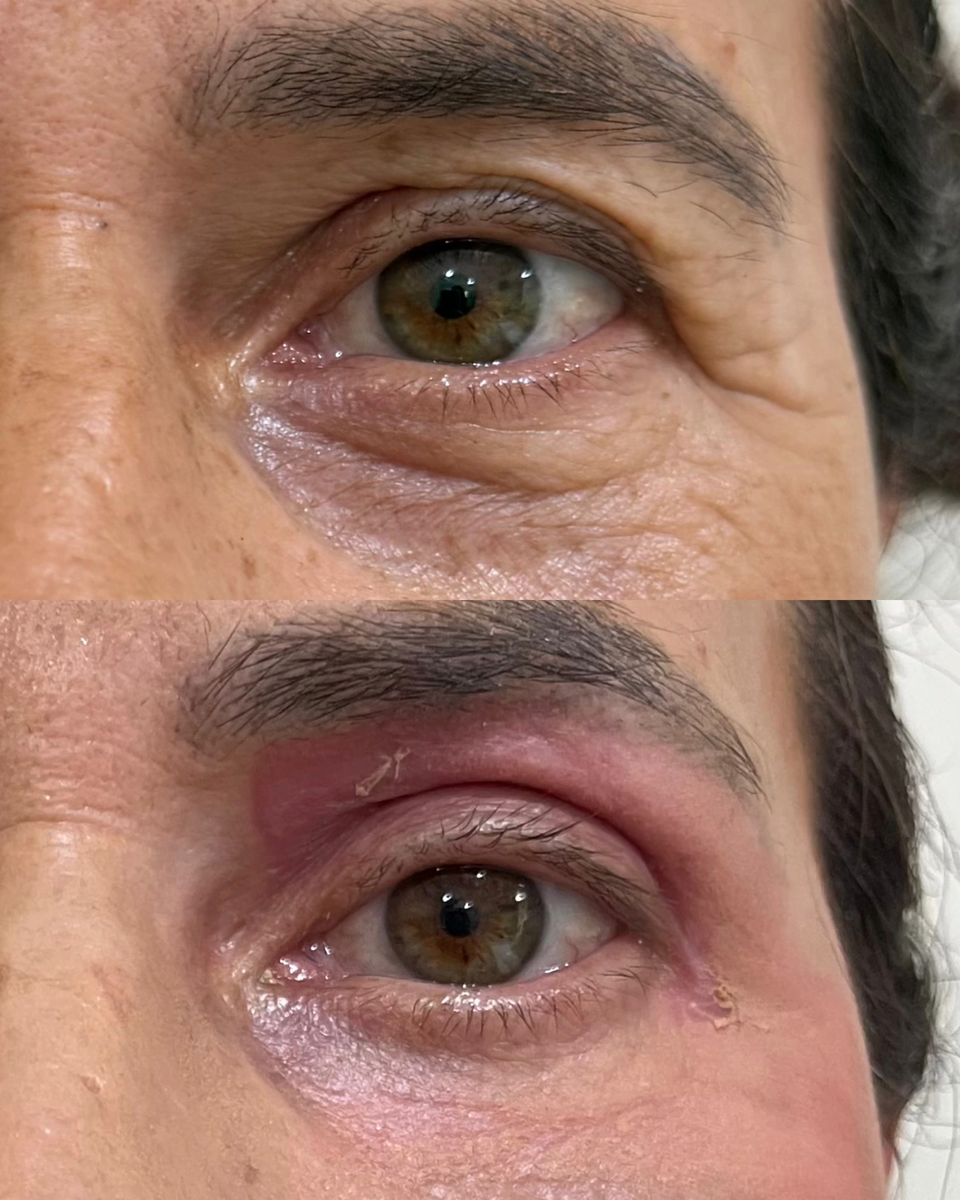 Antes e depois de paciente tratada pela Dra. Vanessa Goes - resultado 24