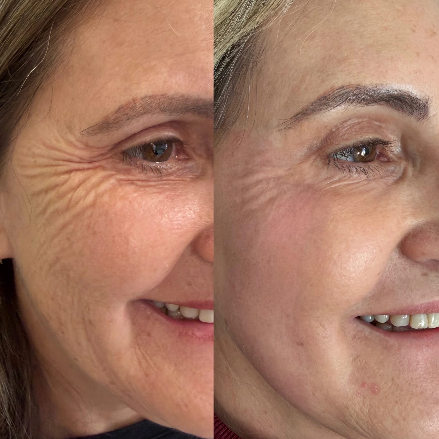 Antes e depois de paciente tratada pela Dra. Vanessa Goes - resultado 26