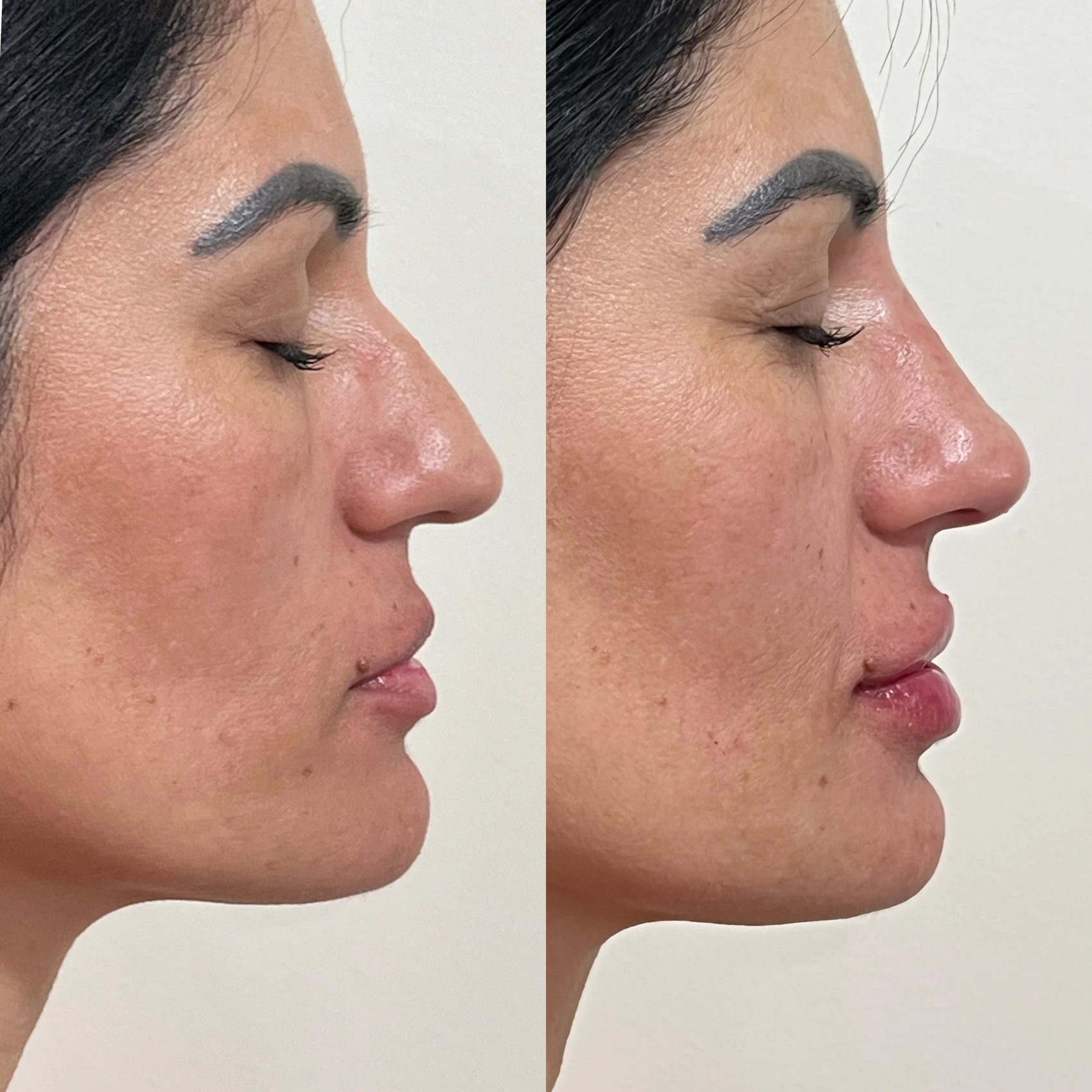 Antes e depois de paciente tratada pela Dra. Vanessa Goes - resultado 27