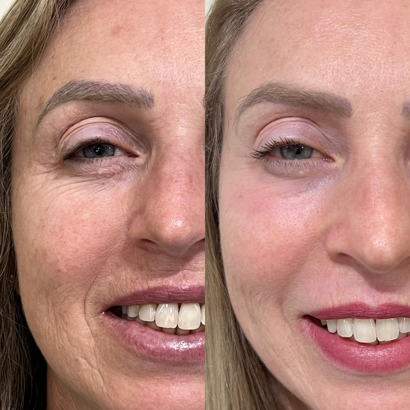 Antes e depois de paciente tratada pela Dra. Vanessa Goes - resultado 28