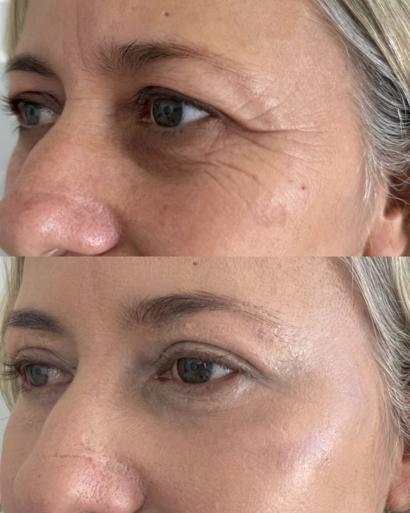 Antes e depois de paciente tratada pela Dra. Vanessa Goes - resultado 29