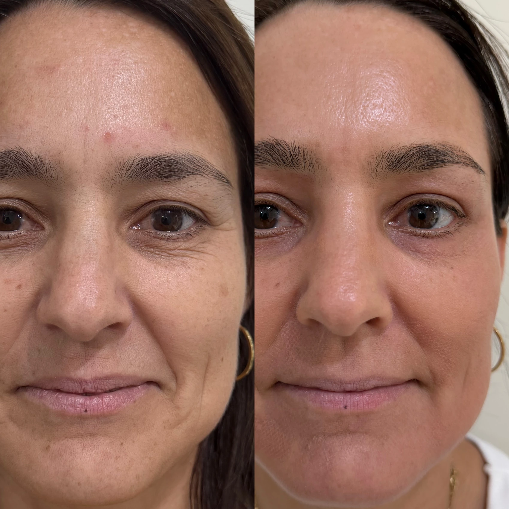 Antes e depois de paciente tratada pela Dra. Vanessa Goes - resultado 30